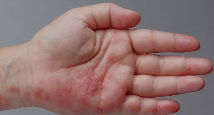 Can Shingles Go Away Without Medication?